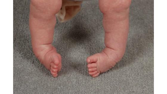 Эквинус стопы у детей: эквинусная установка и деформации ноги - причины и профилактика