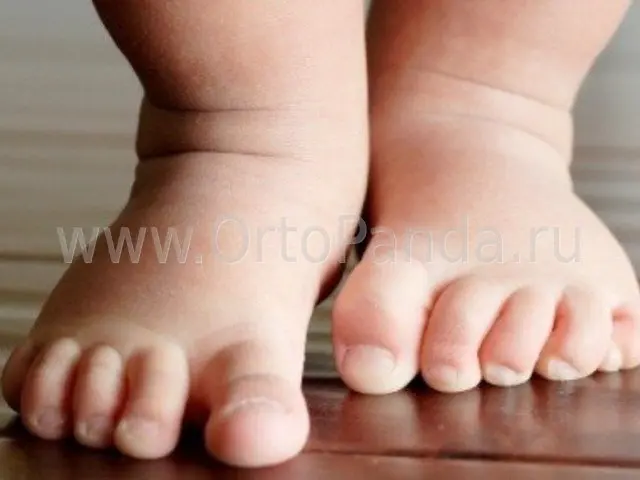 У ребенка ноги косолапые 1 год