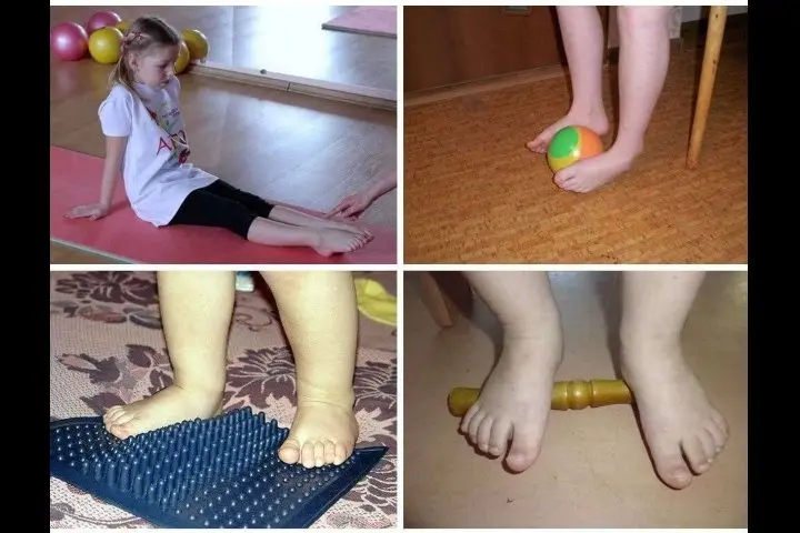 Вальгусная деформация стопы у ребенка в 1-2 года - что это такое: лечение вальгуса ног у детей, причины искривления пятки