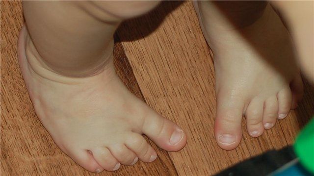 Приводящие стопы у ребенка 1 год
