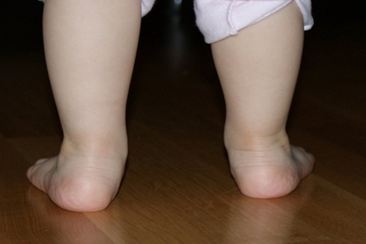 Ребенку 3 года вальгус на одной ножке
